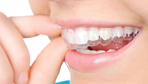 brace in Dubai Silicon Oasis, teeth braces, ceramic braces, braces in dubai, dental braces, metal braces, lingual braces, invisible braces, damon braces, dental braces dubai, cheap braces in dubai, orthodontic braces