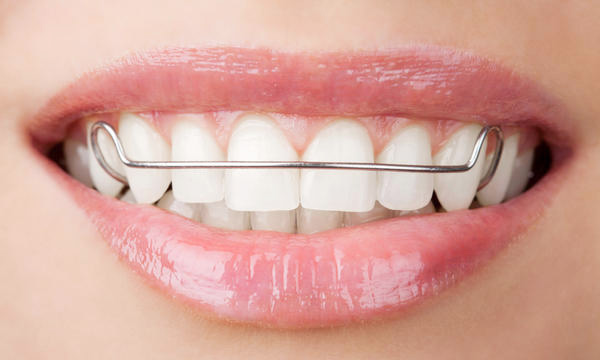 retainers in Dubai Silicon Oasis, teeth braces, ceramic braces, braces in dubai, dental braces, metal braces, lingual braces, invisible braces, damon braces, dental braces dubai, cheap braces in dubai, orthodontic braces