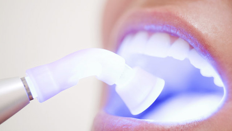 teeth-whitening in Dubai Silicon Oasis
