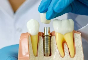 Dental implants DubaI